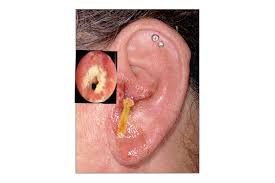 <p><u>initial sx:</u> itching in ear canal<br>typically occurs after swimming</p><p>pain: movement of pinna/chewing→intense</p><p><u>discharge:</u> watery→purulent+thick<br>musty<br>foul-smelling</p><p><u>hearing:</u> exudate+swelling of ear canal→conductive hearing loss</p><p><u>inspection:</u> erythematous+edematous ear canal<br>tympanic membrane obscured</p>