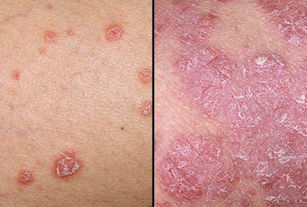 <p>what type of lesion is depicted</p>