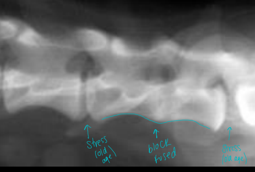 <p>Block vertebrae </p>