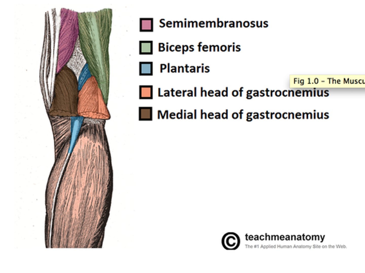 <p>Upper lateral: biceps femoris</p><p>Upper medial: semitendinosus + semimembranosus</p><p>Lower lateral and medial: heads of gastrocnemius</p><p>Floor: popliteus muscle, back capsule of knee joint, popliteal surface of femur</p>