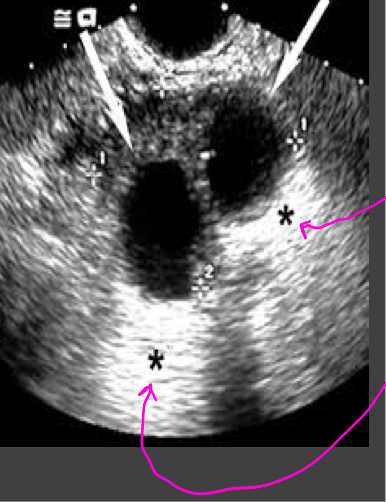 <p>Acoustic enhancement- sound travels through fluid uninterrupted, so the echoes deep to a fluid collection are brighter than the adjacent tissue</p><p>In poorly attenuating objects such as a cyst, the echoes returning from regions deep to the object are of higher amplitude</p>