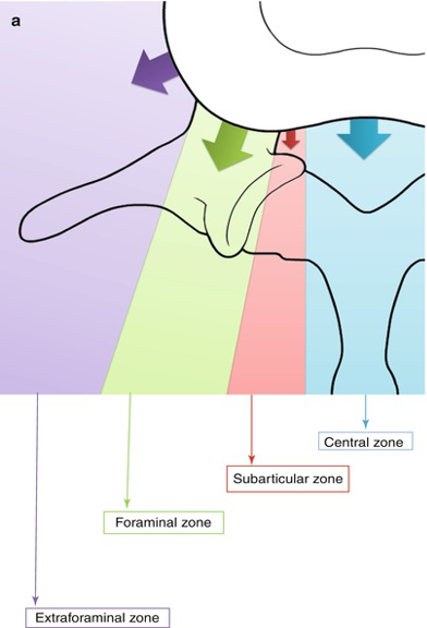 <p>Aka Lateral Recess or Paracentral</p><p>Zone where disc extrudes between the spinal cord and the foramen</p><p>Next to spinous process</p>