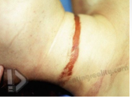 <ul><li><p>pressure on neck applied by object tightened by force other than body weight</p></li><li><p>most commonly associated with rape</p></li><li><p>death due to occlusion of carotid arteries with cerebral hypoxia</p></li><li><p>blood gets to head but can’t drain = congested face, numerous petechiae of sclera and conjunctiva, periorbital and face skin too</p></li></ul><p></p>