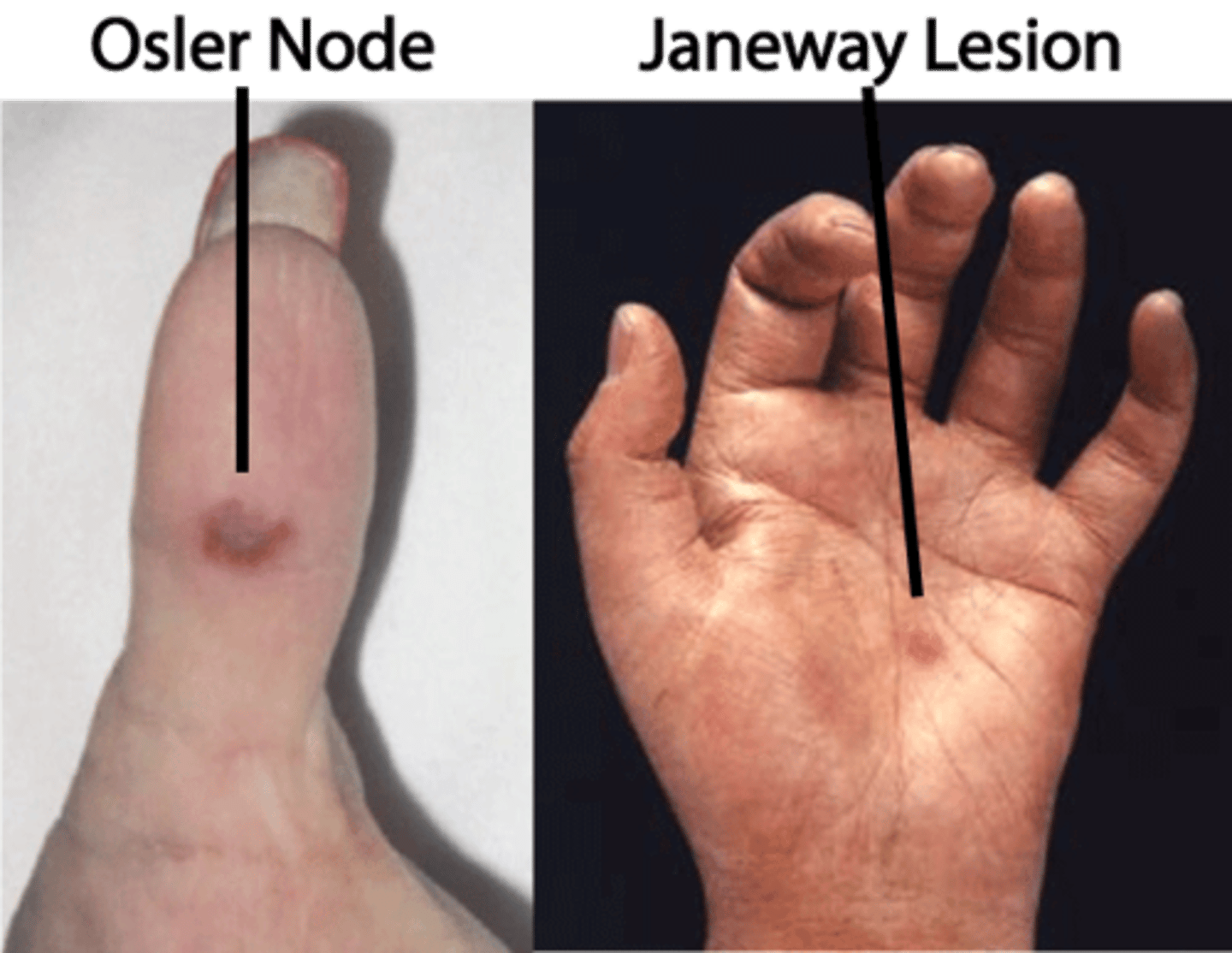 <p>-roth spots (retinal hemorrhages with pale/white centers)</p><p>-petichae</p><p>-osler nodes (painful, tender, red or purple nodules)</p><p>-new onset heart murmur</p><p>-janeway lesions (painless, flat, erythematous macules)</p><p>-anemia</p><p>-splinter nail-bed hemorrhages</p><p>-emboli</p>