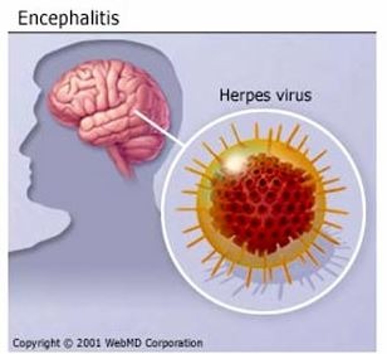 <p>Brain inflammation that usually is the result of a viral illness; resembles the flu and lasts 2-3 weeks; treated with IV fluids</p>