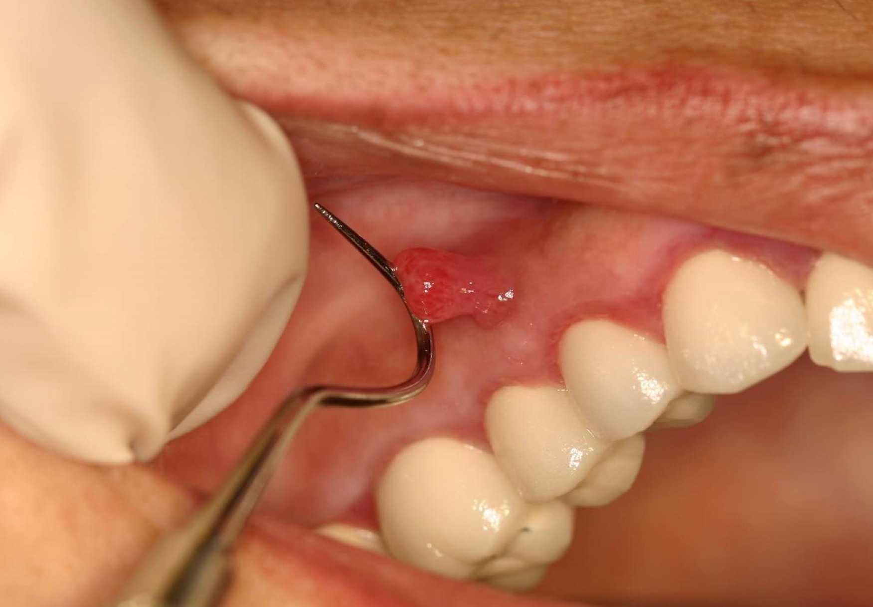 <p>which potential result of periapical inflammation?</p>