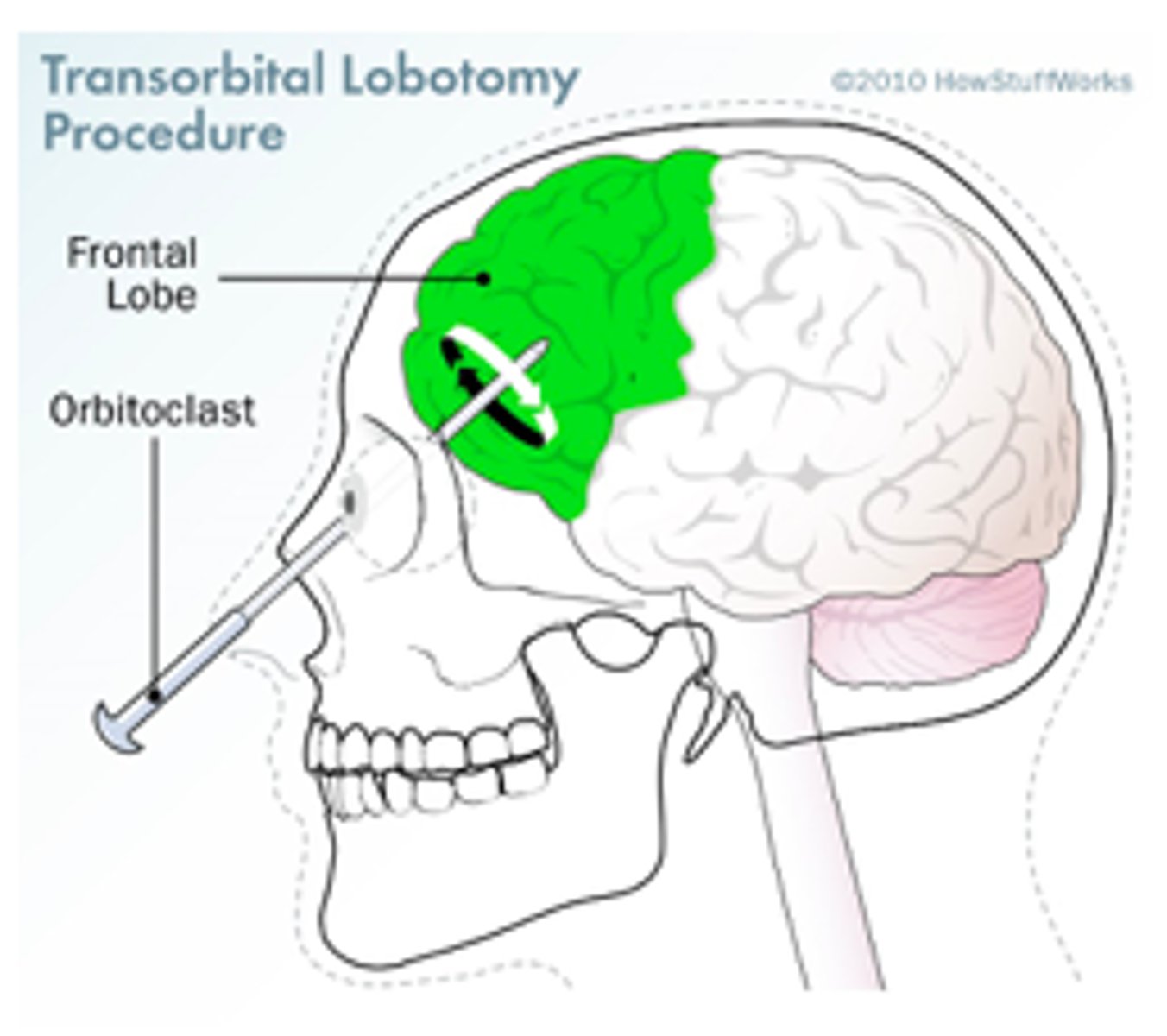 <p>a type of brain surgery that was used to treat mental illness by cutting connections in the brain.</p>