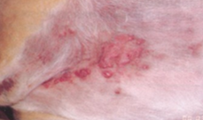 <ul><li><p>rapdi growth </p></li><li><p>ulceration </p></li><li><p>may give rise to small satellite nodules </p></li></ul><p></p>