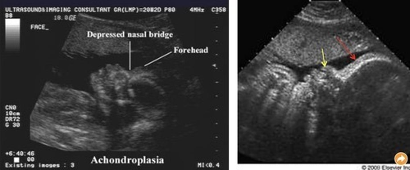 <p>Most common non-lethal skeletal dysplasia</p><p>Fetus looks normal until 24 weeks</p><p>Rhizomelia with bowing femurs</p><p>Frontal bossing</p><p>Trident hands</p>