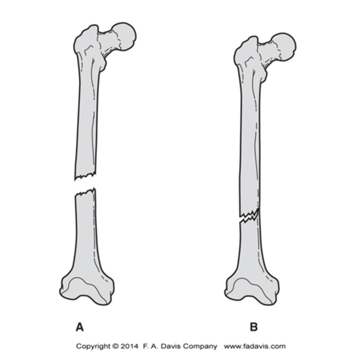 <p>Complete</p><p>- All cortices of the bone has been disrupted</p><p>- Now there are two separate fragments</p><p>- More than two fragments = "Comminuted"</p><p>Incomplete:</p><p>- Only one portion of the cortex is disrupted</p>