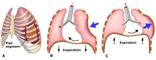 <p>Multiple segmental rib fractures resulting in a free-floating segment of the thoracic wall → severe respiratory distress, pain &amp; hypoventilation</p>