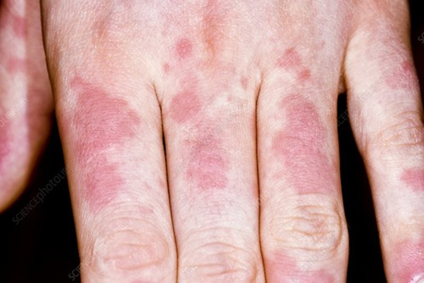 <p>this patient had an allergic reaction to penicillin and reported rashes on their hand. what is this condition known as?</p><p>a. allergies</p><p>b. contact dermatitis</p><p>c. urticaria</p><p>d. psoriasis</p>