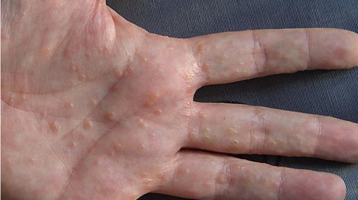 <p>Dyshidrotic Eczema </p>