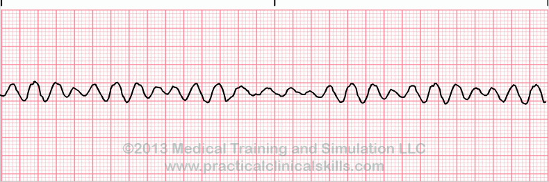 <p>What is this heart rhythm? </p>