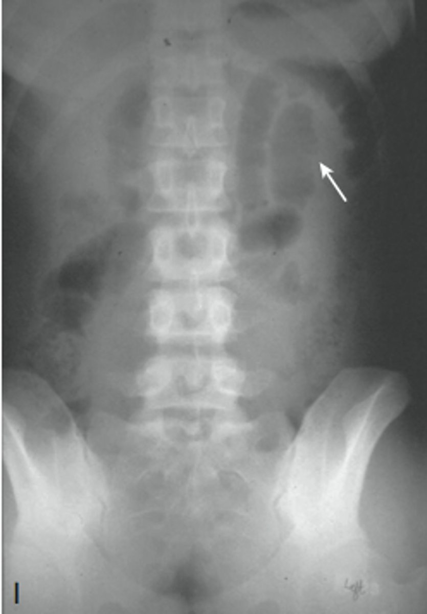<p>local irritation of 1 or more loops of a bowel secondary to inflammation of an adjacent visceral organ, "sentinel loops", loops lose normal fxn and become aperistaltic</p><p>CT scan shows cause</p>