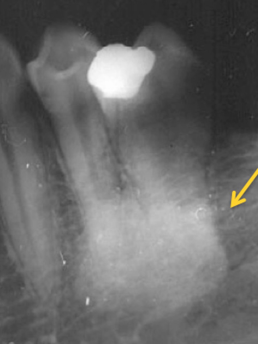 <p>- portion of an image that appears light or white</p><p>- strongly inhibiting the passage of x-rays</p>