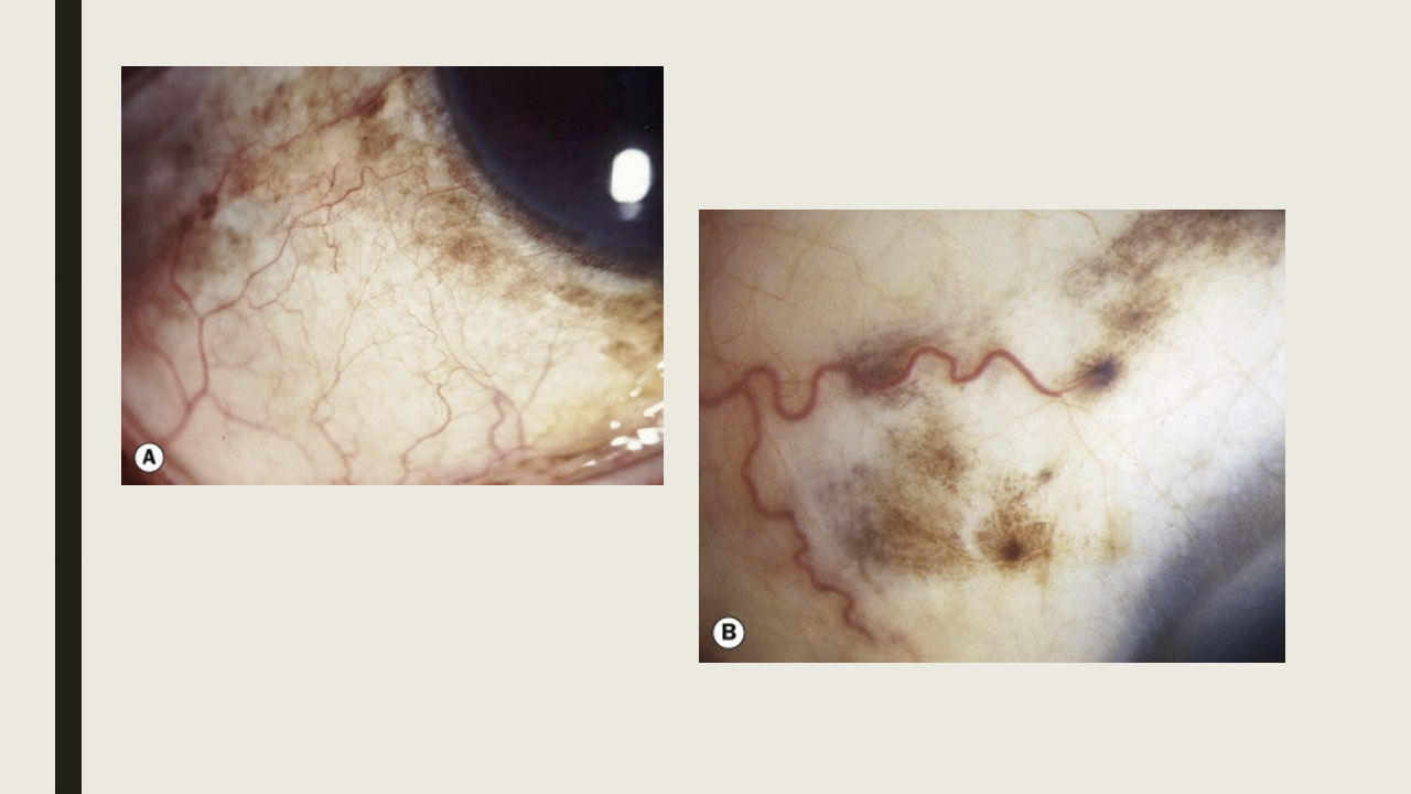 <ul><li><p>Bilateral condition, but bay be asymmetric </p></li><li><p>Flat, patchy brown pigmentation</p></li><li><p>Can be found throughout the conj with a higher conc near the limbus</p></li></ul><p></p>