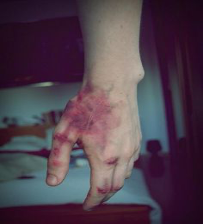 <p>Condition where the blood cannot form clots due to platelet defects = even a minor cut can cause bleed out and death</p><p></p><p>H= no hemophilia</p><p>h= hemophilia</p><p>XHY = make without hemophilia</p><p>XhY = male with hemophilia</p><p>XHXH = female without hemophilia</p><p>XHXh = female without but is a carrier</p>