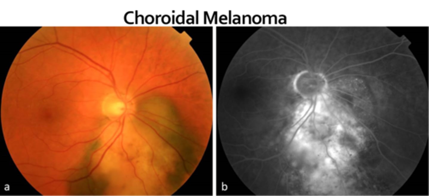 <p>melanoma (but not nevus) will have a double circulation sign = internal circulation within lesion showing it's malignant (but ICGA may be best here bc choroidal)</p>