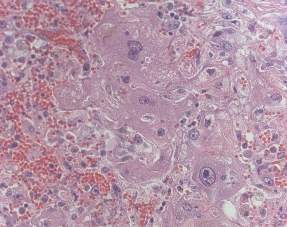 <p>acute: necrosis</p><p>chronic: hepatocytomegaly, biliary hyperplasia, fibrosis</p>