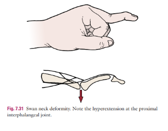 <p>Swan Neck Deformity</p>