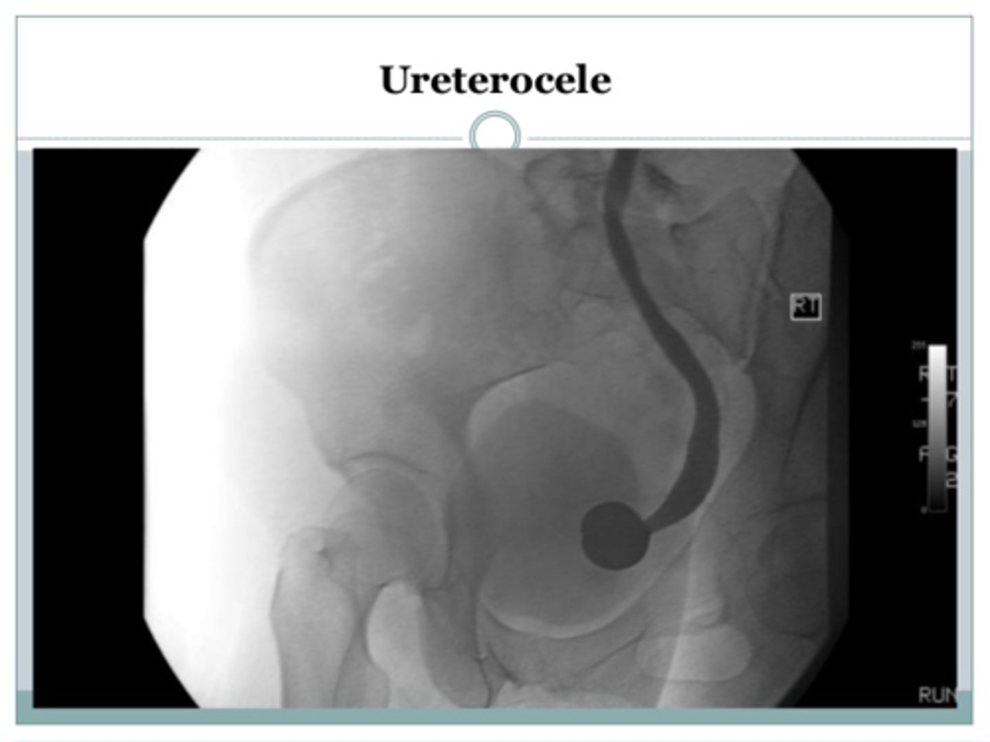 <p>Wat is een uretrocoele? (oorzaak hydronefrose)</p>