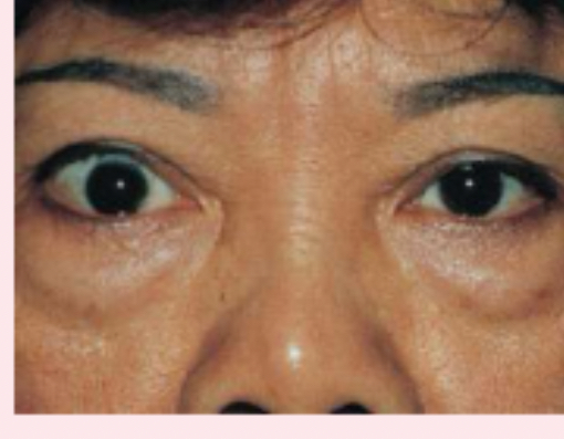 <p>exophthalmos</p>