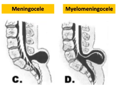 <p>Spina bifida cystica</p>