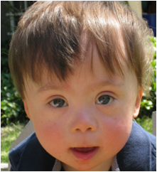 mild to severe intellectual disability and associated physical disorders extra copy of chromosome 21
