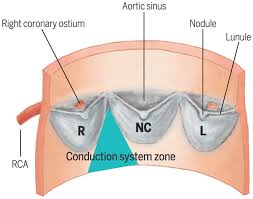 <p>en el origen del tronco pulmonar y aorta ascendente entre la pared del vaso y cada valvula de las valvas</p>