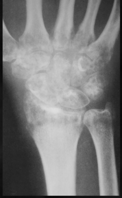 <p>what is seen here for this case of regional osteoporosis?</p>