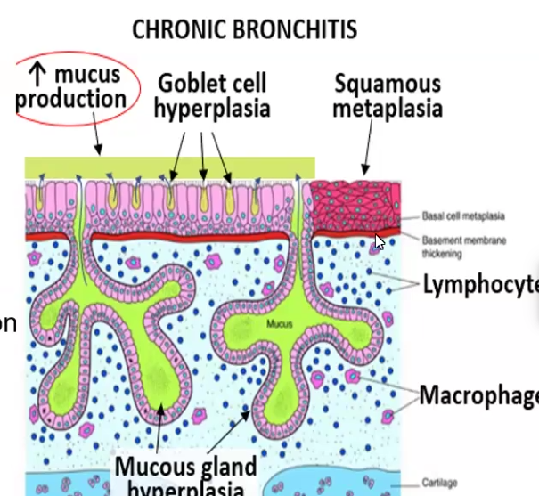 <ul><li><p>Defined as persistent productive cough for at least 3 consecutive months in at least 2 consecutive years</p></li><li><p>Causes include cigarette smokers (%90) and urban dwellers in smog-ridden cities</p></li><li><p>Pathogenesis: exposure to noxious inhalants causes <strong>goblet cell hyperplasia</strong>, hyperplasia/hypertrophy in submucosal mucinous glands, inflammation, squamous metaplasia leading to fibrosis and narrowing of lumen in smaller airways</p></li><li><p>Clinical Features: Mucus hypersecretion, productive cough for 3 months, “blue bloater” due to hypoxemia, may lead to Cor Pulmonale (Right Heart Failure) due to over-exertion of right ventricle</p></li></ul><p></p>