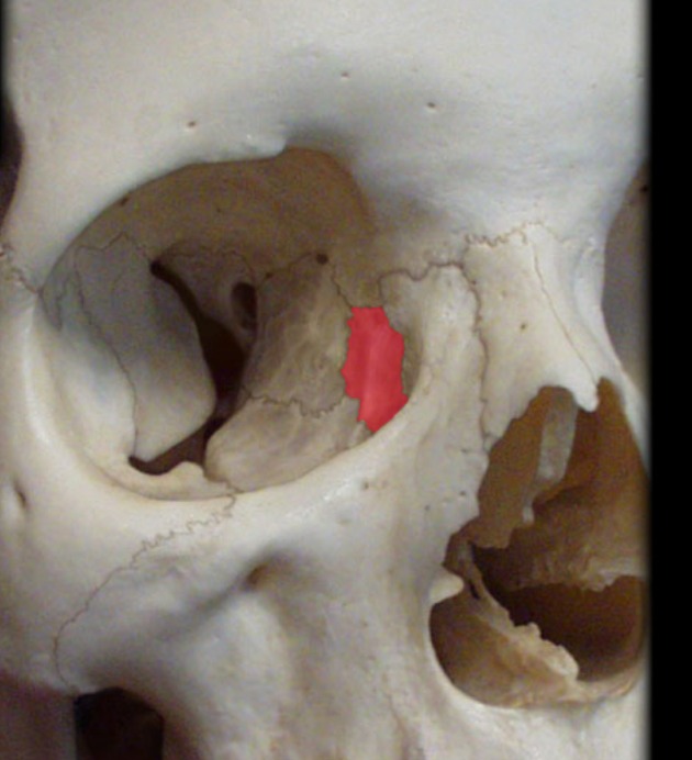 <p>medial part of the eye socket; next to maxillary bone</p>