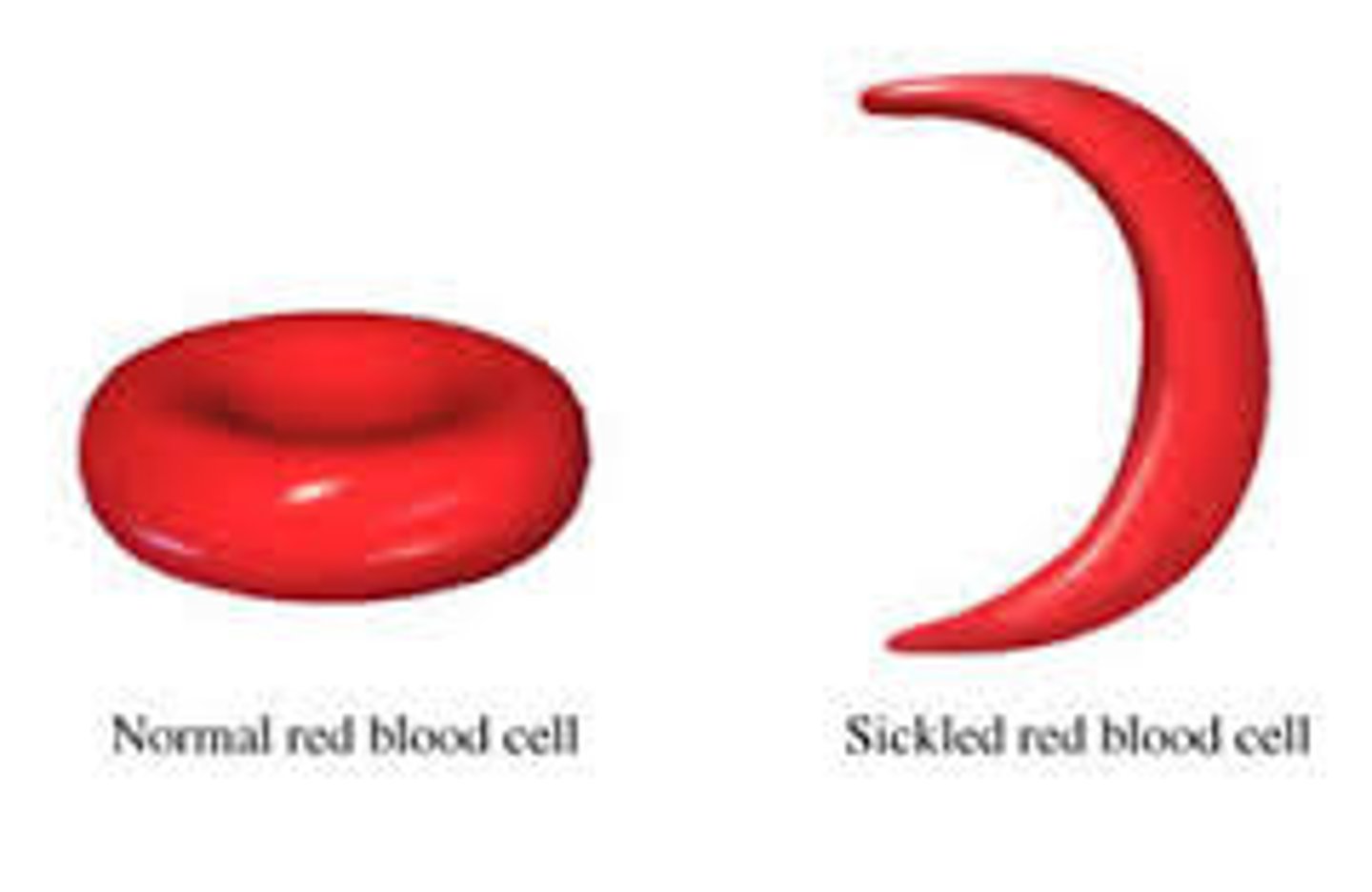 <p>- mutation in hemoglobin.</p><p>- look "sickled" &amp; are easily damaged.</p><p>- may get stuck in narrow vessels &amp; block oxygen from getting to tissues.</p>