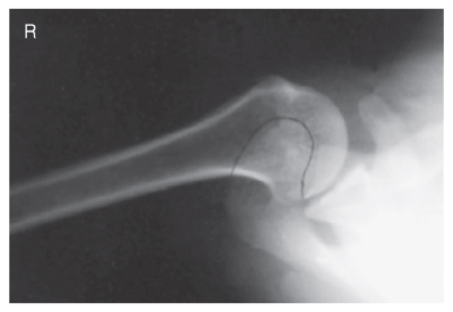 <p>- CR 25° to 30° medial to axilla</p><p>- Arm supinated, abducted 90° (or as near 90° as possible)</p><p>- Supine with shoulder elevated 2" from the TT, sponge</p><p>- Lesser tubercle profiled anteriorly</p><p>- Humeral head and glenoid fossa profiled</p><p>- Optimal exposure factors</p>