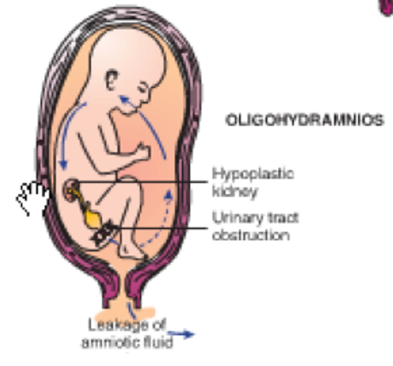 <p>Oligohydramnios</p><p>The nurse should identify that oligohydramnios requires further fetal assessment using electronic fetal monitoring. Other conditions that require further assessment include hypertension, diabetes, intrauterine growth restriction, renal disease, decreased fetal movement, previous fetal death, post-term pregnancy, systemic lupus erythematosus, and intrahepatic cholestasis.</p>