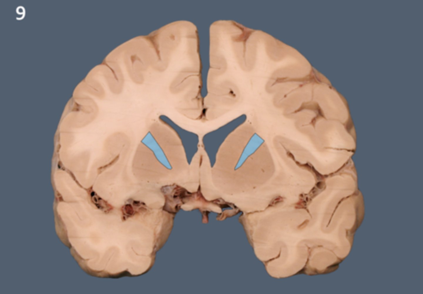 <p>White matter pathway is lateral to the caudate nucleus, between the caudate and the putamen (and globus pallidus). It carries primarily motor fibers, including corticospinal tract fibers.</p>