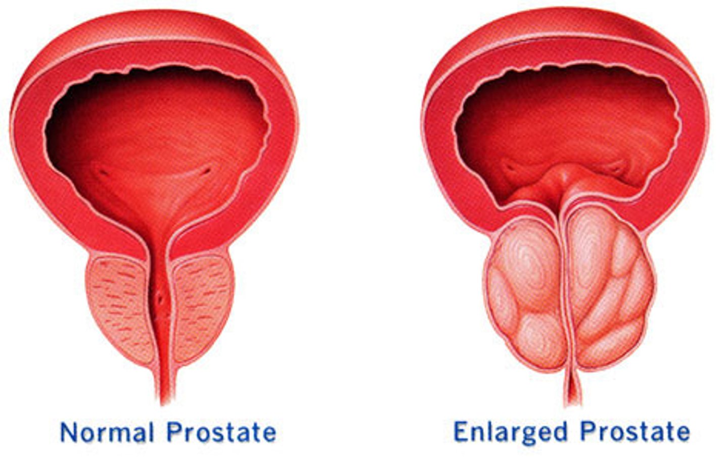 <p>enlarged prostate</p>