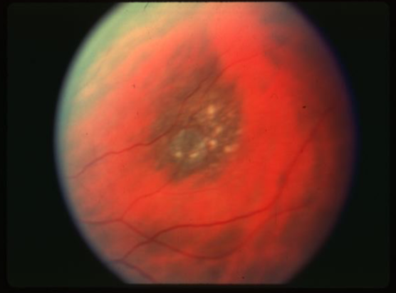 <p>what is the concern for this being melanoma? </p>