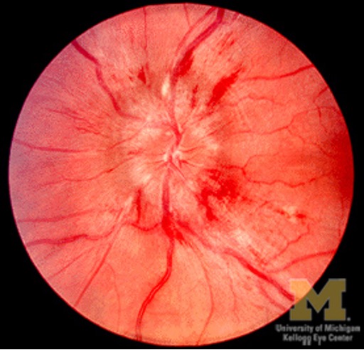 <p>What condition?</p><ul><li><p>sign of increased ICP</p></li><li><p>usually b/l (binocular vision disorder)</p></li><li><p>HA, N/V, other neuro dysfunction</p></li><li><p>urgent search for cause (HTN emergency, mass, etc)</p></li></ul><p></p>