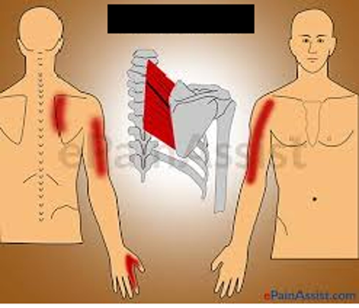 <p>myofacial pain</p>
