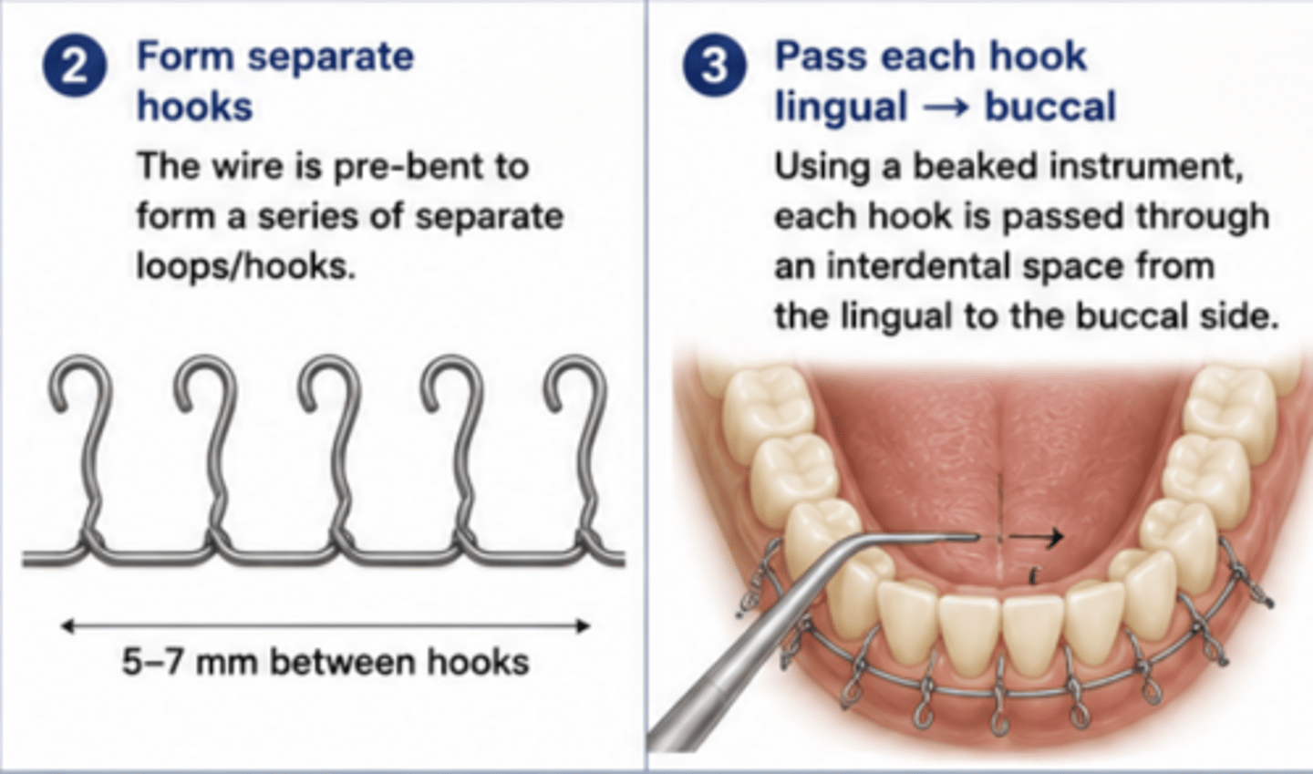 <p>0.4mm thick, 70-80cm long wire </p><p>- form separate loops and hooks, drive them between the teeth from lingual to buccal direction </p><p>- adjacent hooks are twisted together in pairs on the buccal side</p><p>- The enlarged hooks serve as attachment points for:</p><p>elastics</p><p>ligature wires</p><p>to achieve intermaxillary fixation (IMF).</p>