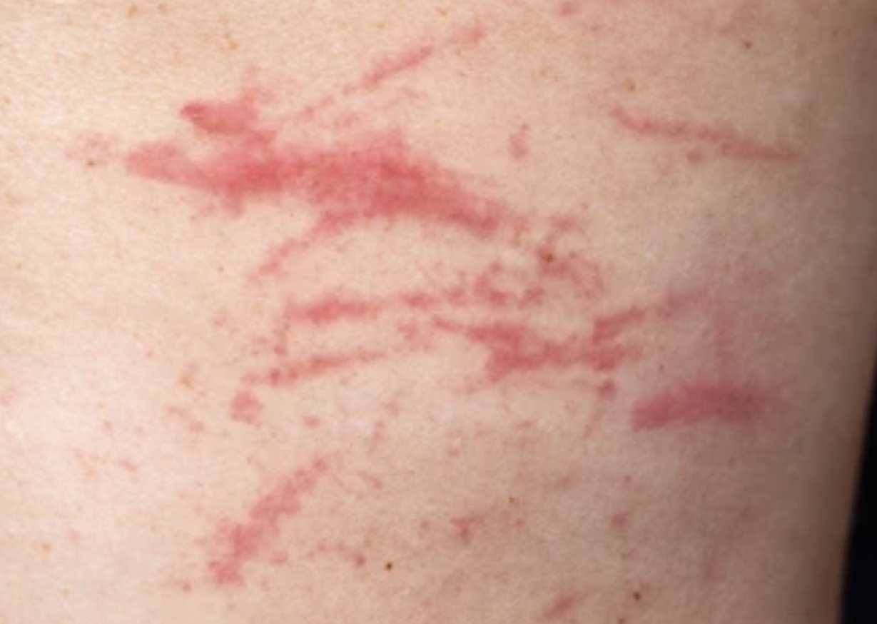 <p>Excoriation</p>