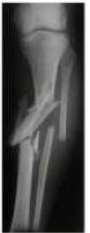 <p>what type of fracture is this?</p>