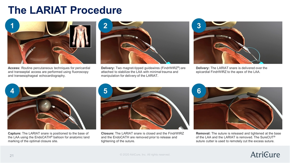 <ol><li><p>Lariat device</p></li><li><p>Epicardial</p></li><li><p>Closing t</p></li></ol><p></p>