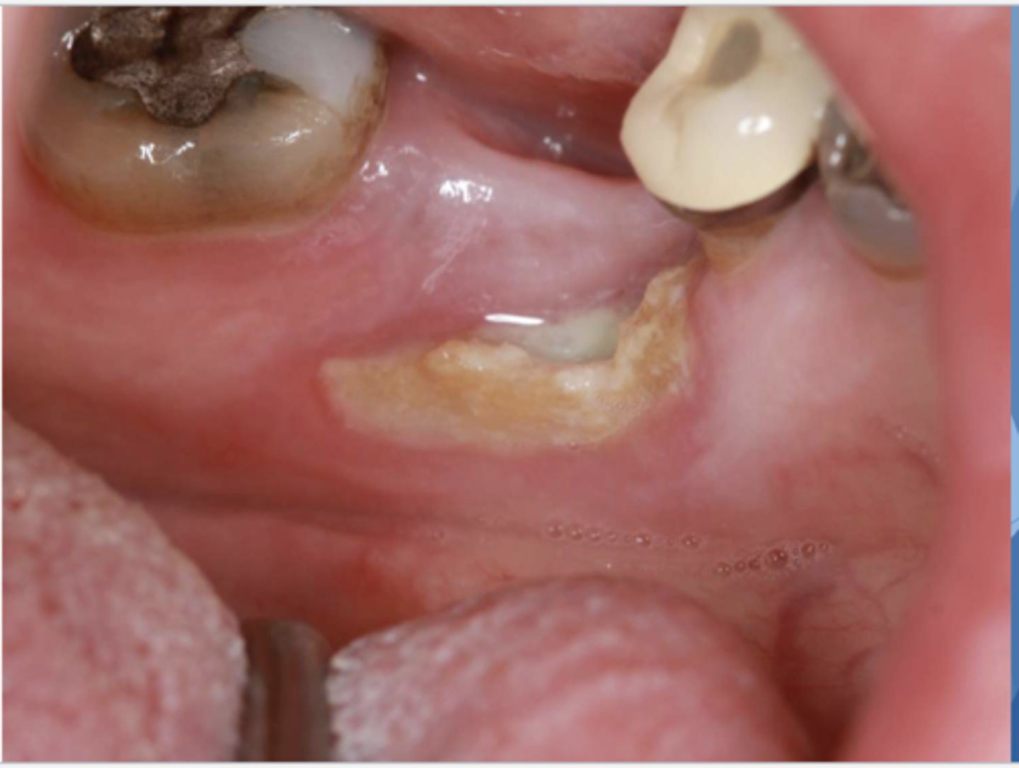 <p>What do you suspect? Hint: Patient is taking Zometa to treat osteoporosis</p>