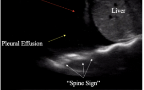 <p>What is the spine sign?</p>