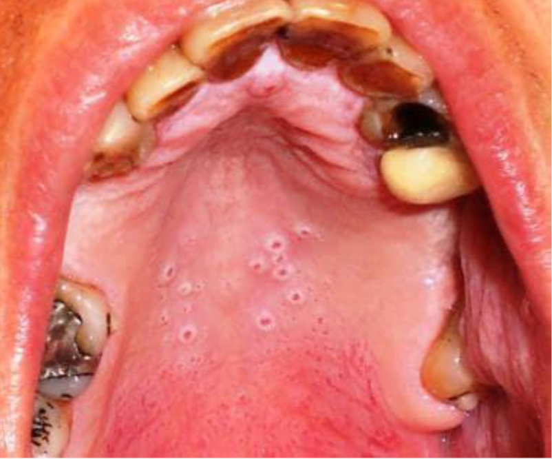 <p>Case 13. A 57-year-old male presents for a routine dental checkup. Patient smokes a pipe. 13a. What is the MOST likely diagnosis based on the clinical presentation?</p>