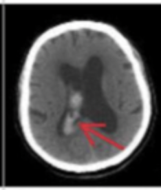 <p>What type of intracranial hemorrhage is associated with both intraparenchymal and SAH?</p>