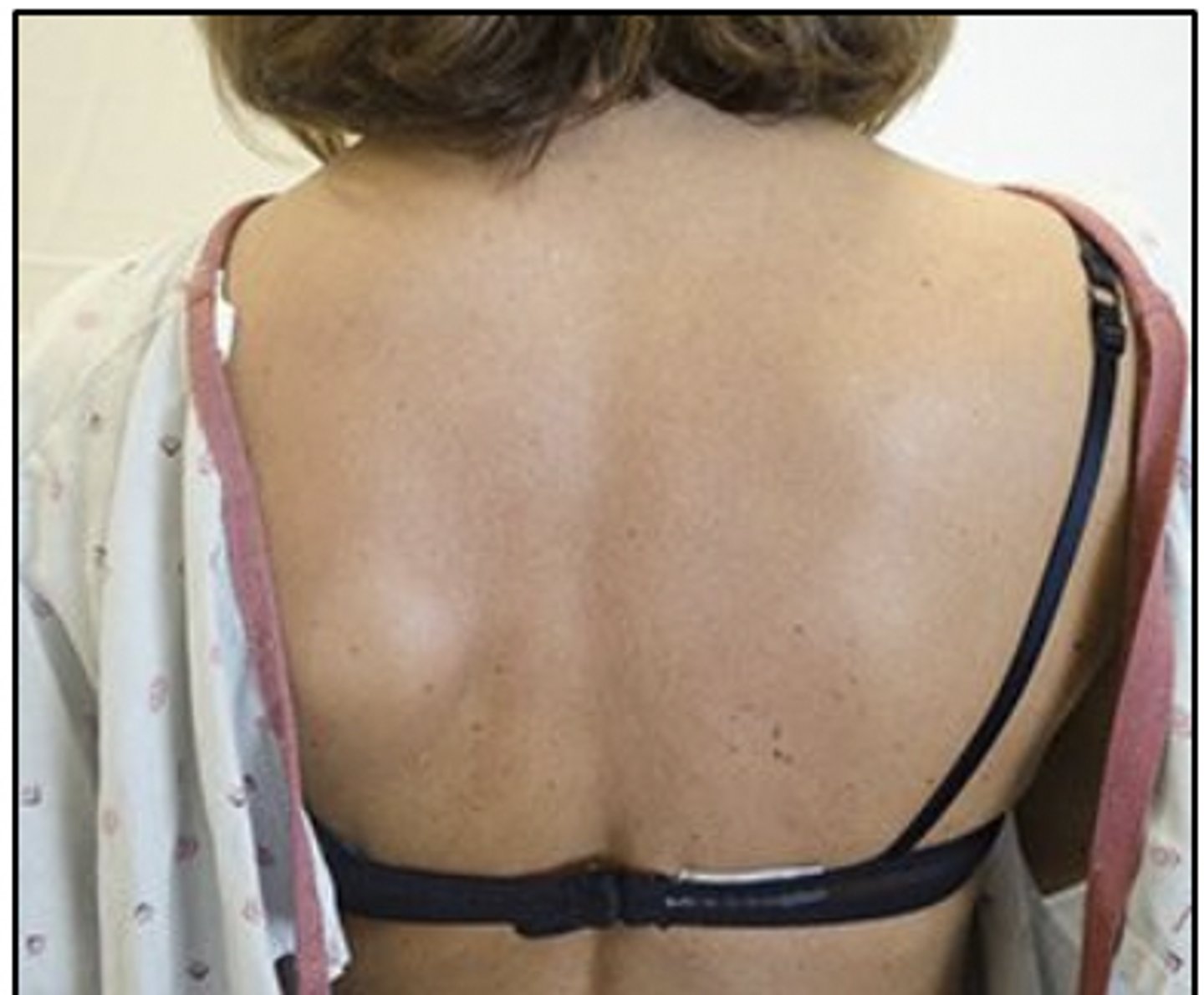 <p>Rationale</p><p>1. The long thoracic nerve innervates the serratus anterior. Weakness of the serratus anterior results in winging of the scapula, which is the pathological position shown in the photograph. (Magee, p. 281; Drake, pp. 726-727, 744)</p><p>2. The spinal accessory nerve innervates the sternocleidomastoid and trapezius. The trapezius adducts and upwardly rotates the scapula (Drake, pp. 895, 1024). The sternocleidomastoid flexes the head to the side and rotates the head to the contralateral side (Magee, p. 174). These muscles are not involved in the asymmetrical position shown in the photograph.</p><p>3. The axillary nerve innervates the deltoid and teres minor, which are not involved in the asymmetrical position shown in the photograph (Magee, pp. 177, 287).</p><p>4. The dorsal scapular nerve innervates the rhomboids, which elevate, retract, and downwardly rotate the scapula and are not involved in the asymmetrical position shown in the photograph (Drake, pp. 715-716, 744; Magee, p. 287).</p>